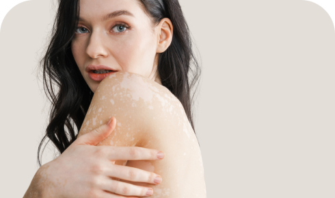 treatments.items.vitiligo.title